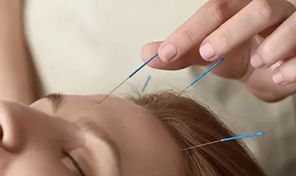 Αισθητικός Βελονισμός Αισθητικός Βελονισμός